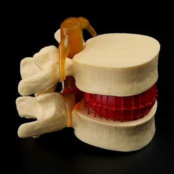 Анатомический позвоночник, грыжа поясничного диска, медицинский учебный инструмент по анатомии